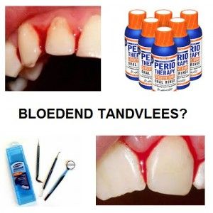 bloedend tandvlees