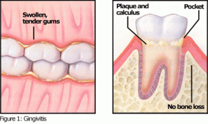 gingivitis2