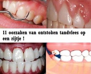 oorzaak ontstoken tandvlees