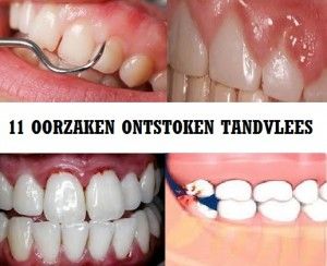 molecuul Belegering levend 11 Oorzaken ontstoken tandvlees op een rijtje! – Ontstoken Tandvlees? |  Top10 Tips – Beste Middelen