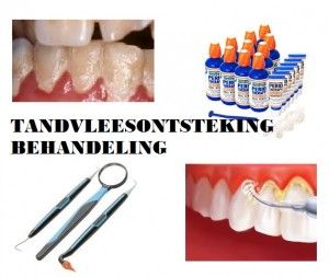 tandvleesontsteking behandeling