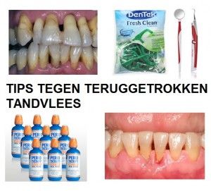 teruggetrokken tandvlees