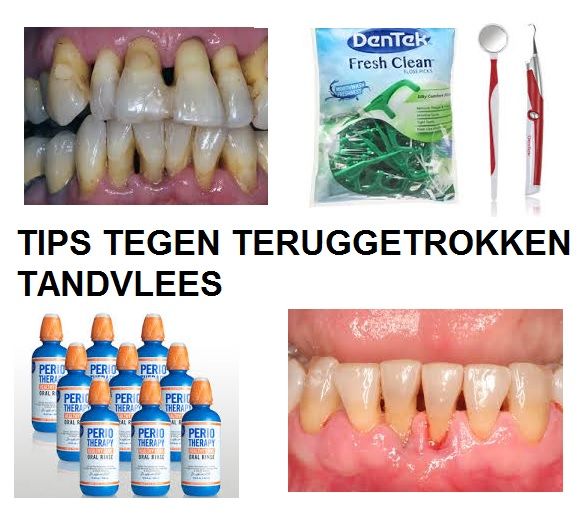 Terugtrekkend tandvlees? 10 Tips en behandeling!