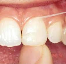 wat te doen tegen tandvleesontsteking