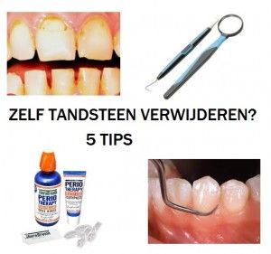 zelf tandsteen verwijderen